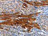 The image on the left is immunohistochemistry of paraffin-embedded Human liver cancer tissue using CSB-PA598136 (AOX1 Antibody) at dilution 1/65, on the right is treated with fusion protein. (Original magnification: ×200)