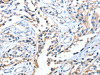 The image on the left is immunohistochemistry of paraffin-embedded Human esophagus cancer tissue using CSB-PA598136 (AOX1 Antibody) at dilution 1/65, on the right is treated with fusion protein. (Original magnification: ×200)