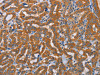 The image on the left is immunohistochemistry of paraffin-embedded Human thyroid cancer tissue using CSB-PA951869 (ALDH3A1 Antibody) at dilution 1/30, on the right is treated with fusion protein. (Original magnification: ×200)