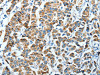 The image on the left is immunohistochemistry of paraffin-embedded Human breast cancer tissue using CSB-PA935612 (ALDH4A1 Antibody) at dilution 1/45, on the right is treated with fusion protein. (Original magnification: ×200)