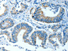 The image on the left is immunohistochemistry of paraffin-embedded Human colon cancer tissue using CSB-PA252846 (ALDH4A1 Antibody) at dilution 1/35, on the right is treated with fusion protein. (Original magnification: ×200)
