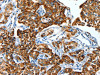 The image on the left is immunohistochemistry of paraffin-embedded Human lung cancer tissue using CSB-PA925196 (ALDH6A1 Antibody) at dilution 1/45, on the right is treated with fusion protein. (Original magnification: ×200)
