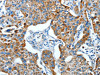 The image on the left is immunohistochemistry of paraffin-embedded Human lung cancer tissue using CSB-PA280938 (ALDH6A1 Antibody) at dilution 1/45, on the right is treated with fusion protein. (Original magnification: ×200)