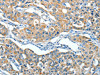 The image on the left is immunohistochemistry of paraffin-embedded Human lung cancer tissue using CSB-PA830209 (SERPINA3 Antibody) at dilution 1/55, on the right is treated with fusion protein. (Original magnification: ×200)