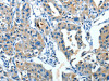 The image on the left is immunohistochemistry of paraffin-embedded Human lung cancer tissue using CSB-PA879441 (SERPINA3 Antibody) at dilution 1/35, on the right is treated with fusion protein. (Original magnification: ×200)