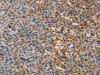 The image on the left is immunohistochemistry of paraffin-embedded Human liver cancer tissue using CSB-PA083278 (AMBP Antibody) at dilution 1/35, on the right is treated with fusion protein. (Original magnification: ×200)