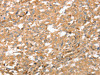 The image on the left is immunohistochemistry of paraffin-embedded Human thyroid cancer tissue using CSB-PA241286 (AHSG Antibody) at dilution 1/60, on the right is treated with fusion protein. (Original magnification: ×200)