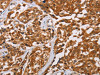 The image on the left is immunohistochemistry of paraffin-embedded Human esophagus cancer tissue using CSB-PA098689 (CRYAB Antibody) at dilution 1/20, on the right is treated with fusion protein. (Original magnification: ×200)