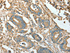 The image on the left is immunohistochemistry of paraffin-embedded Human colon cancer tissue using CSB-PA906019 (ACTN1 Antibody) at dilution 1/10, on the right is treated with fusion protein. (Original magnification: ×200)