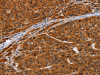 The image on the left is immunohistochemistry of paraffin-embedded Human liver cancer tissue using CSB-PA076874 (NIF3L1 Antibody) at dilution 1/20, on the right is treated with fusion protein. (Original magnification: ×200)