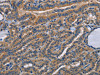 The image on the left is immunohistochemistry of paraffin-embedded Human thyroid cancer tissue using CSB-PA052910 (STRADB Antibody) at dilution 1/15, on the right is treated with fusion protein. (Original magnification: ×200) The image on the left is immunohistochemistry of paraffin-embedded Human thyroid cancer tissue using CSB-PA052910 (STRADB Antibody) at dilution 1/15, on the right is treated with fusion protein. (Original magnification: ×200)
