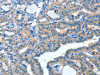 The image on the left is immunohistochemistry of paraffin-embedded Human thyroid cancer tissue using CSB-PA984808 (AMDHD2 Antibody) at dilution 1/30, on the right is treated with fusion protein. (Original magnification: ×200)