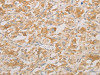 The image on the left is immunohistochemistry of paraffin-embedded Human thyroid cancer tissue using CSB-PA551903 (AES Antibody) at dilution 1/20, on the right is treated with fusion protein. (Original magnification: ×200)