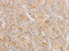 The image on the left is immunohistochemistry of paraffin-embedded Human liver cancer tissue using CSB-PA551903 (AES Antibody) at dilution 1/20, on the right is treated with fusion protein. (Original magnification: ×200)