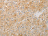 The image on the left is immunohistochemistry of paraffin-embedded Human liver cancer tissue using CSB-PA973928 (AES Antibody) at dilution 1/20, on the right is treated with fusion protein. (Original magnification: ×200)