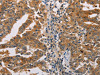The image on the left is immunohistochemistry of paraffin-embedded Human gastic cancer tissue using CSB-PA616041 (ACY1 Antibody) at dilution 1/25, on the right is treated with fusion protein. (Original magnification: ×200)