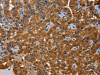 The image on the left is immunohistochemistry of paraffin-embedded Human thyroid cancer tissue using CSB-PA287728 (ACY1 Antibody) at dilution 1/20, on the right is treated with fusion protein. (Original magnification: ×200)