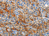 The image on the left is immunohistochemistry of paraffin-embedded Human liver cancer tissue using CSB-PA477062 (STAMBP Antibody) at dilution 1/15, on the right is treated with fusion protein. (Original magnification: ×200)