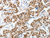 The image on the left is immunohistochemistry of paraffin-embedded Human breast cancer tissue using CSB-PA574741 (ANXA10 Antibody) at dilution 1/35, on the right is treated with fusion protein. (Original magnification: ×200)