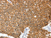 The image on the left is immunohistochemistry of paraffin-embedded Human lung cancer tissue using CSB-PA579076 (ANXA9 Antibody) at dilution 1/20, on the right is treated with fusion protein. (Original magnification: ×200)