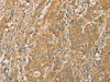 The image on the left is immunohistochemistry of paraffin-embedded Human gastic cancer tissue using CSB-PA273741 (SNAP91 Antibody) at dilution 1/20, on the right is treated with fusion protein. (Original magnification: ×200)