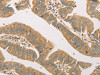 The image on the left is immunohistochemistry of paraffin-embedded Human colon cancer tissue using CSB-PA273741 (SNAP91 Antibody) at dilution 1/20, on the right is treated with fusion protein. (Original magnification: ×200)