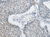 The image on the left is immunohistochemistry of paraffin-embedded Human lung cancer tissue using CSB-PA227771 (AP2M1 Antibody) at dilution 1/15, on the right is treated with fusion protein. (Original magnification: ×200)