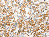 The image on the left is immunohistochemistry of paraffin-embedded Human thyroid cancer tissue using CSB-PA596504 (ANAPC2 Antibody) at dilution 1/30, on the right is treated with fusion protein. (Original magnification: ×200)