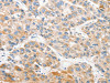 The image on the left is immunohistochemistry of paraffin-embedded Human liver cancer tissue using CSB-PA596504 (ANAPC2 Antibody) at dilution 1/30, on the right is treated with fusion protein. (Original magnification: ×200)