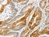 The image on the left is immunohistochemistry of paraffin-embedded Human colon cancer tissue using CSB-PA937183 (ANAPC2 Antibody) at dilution 1/20, on the right is treated with fusion protein. (Original magnification: ×200)