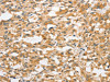 The image on the left is immunohistochemistry of paraffin-embedded Human thyroid cancer tissue using CSB-PA187039 (ANAPC5 Antibody) at dilution 1/30, on the right is treated with fusion protein. (Original magnification: ×200)