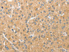 The image on the left is immunohistochemistry of paraffin-embedded Human liver cancer tissue using CSB-PA187039 (ANAPC5 Antibody) at dilution 1/30, on the right is treated with fusion protein. (Original magnification: ×200)