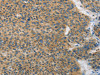 The image on the left is immunohistochemistry of paraffin-embedded Human liver cancer tissue using CSB-PA906762 (ANAPC13 Antibody) at dilution 1/25, on the right is treated with fusion protein. (Original magnification: ×200)