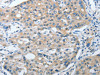 The image on the left is immunohistochemistry of paraffin-embedded Human lung cancer tissue using CSB-PA906762 (ANAPC13 Antibody) at dilution 1/25, on the right is treated with fusion protein. (Original magnification: ×200)
