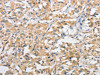 The image on the left is immunohistochemistry of paraffin-embedded Human thyroid cancer tissue using CSB-PA167980 (ATG10 Antibody) at dilution 1/60, on the right is treated with fusion protein. (Original magnification: ×200)