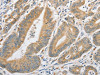 The image on the left is immunohistochemistry of paraffin-embedded Human colon cancer tissue using CSB-PA828297 (ATG10 Antibody) at dilution 1/60, on the right is treated with fusion protein. (Original magnification: ×200)
