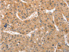 The image on the left is immunohistochemistry of paraffin-embedded Human liver cancer tissue using CSB-PA313566 (ATG12 Antibody) at dilution 1/70, on the right is treated with fusion protein. (Original magnification: ×200)