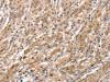 The image on the left is immunohistochemistry of paraffin-embedded Human gastric cancer tissue using CSB-PA313566 (ATG12 Antibody) at dilution 1/70, on the right is treated with fusion protein. (Original magnification: ×200)