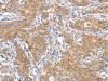 The image on the left is immunohistochemistry of paraffin-embedded Human gastic cancer tissue using CSB-PA065886 (ATG12 Antibody) at dilution 1/40, on the right is treated with fusion protein. (Original magnification: ×200)