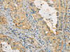 The image on the left is immunohistochemistry of paraffin-embedded Human cervical cancer tissue using CSB-PA042329 (APOA4 Antibody) at dilution 1/30, on the right is treated with fusion protein. (Original magnification: ×200)