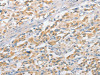 The image on the left is immunohistochemistry of paraffin-embedded Human thyroid cancer tissue using CSB-PA706929 (APPBP2 Antibody) at dilution 1/25, on the right is treated with fusion protein. (Original magnification: ×200)