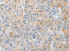 The image on the left is immunohistochemistry of paraffin-embedded Human liver cancer tissue using CSB-PA706929 (APPBP2 Antibody) at dilution 1/25, on the right is treated with fusion protein. (Original magnification: ×200)