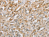 The image on the left is immunohistochemistry of paraffin-embedded Human thyroid cancer tissue using CSB-PA244536 (NAPSA Antibody) at dilution 1/40, on the right is treated with fusion protein. (Original magnification: ×200)