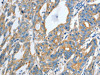 The image on the left is immunohistochemistry of paraffin-embedded Human gastric cancer tissue using CSB-PA935662 (TNFSF13 Antibody) at dilution 1/30, on the right is treated with fusion protein. (Original magnification: ×200)