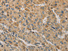 The image on the left is immunohistochemistry of paraffin-embedded Human liver cancer tissue using CSB-PA167583 (MIP Antibody) at dilution 1/60, on the right is treated with fusion protein. (Original magnification: ×200)