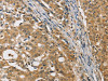 The image on the left is immunohistochemistry of paraffin-embedded Human gastric cancer tissue using CSB-PA283369 (MIP Antibody) at dilution 1/50, on the right is treated with fusion protein. (Original magnification: ×200)