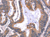 The image on the left is immunohistochemistry of paraffin-embedded Human colon cancer tissue using CSB-PA698018 (ARC Antibody) at dilution 1/50, on the right is treated with fusion protein. (Original magnification: ×200)