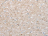 The image on the left is immunohistochemistry of paraffin-embedded Human brain tissue using CSB-PA905307 (ARHGAP1 Antibody) at dilution 1/25, on the right is treated with fusion protein. (Original magnification: ×200)