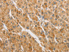 The image on the left is immunohistochemistry of paraffin-embedded Human liver cancer tissue using CSB-PA564021 (ARHGAP5 Antibody) at dilution 1/30, on the right is treated with fusion protein. (Original magnification: ×200)