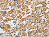 The image on the left is immunohistochemistry of paraffin-embedded Human thyroid cancer tissue using CSB-PA990163 (ARHGAP15 Antibody) at dilution 1/50, on the right is treated with fusion protein. (Original magnification: ×200)
